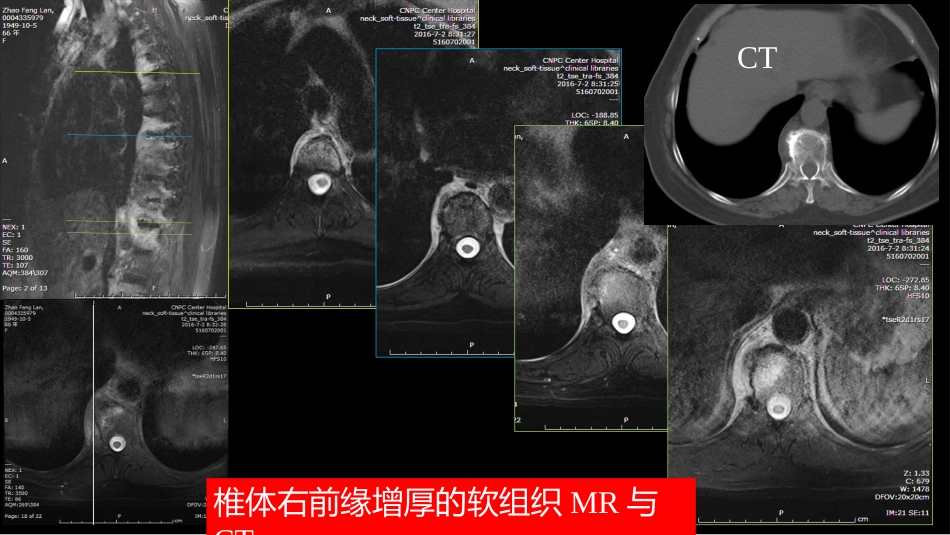 椎体局灶性病变：综合影像学评判_第5页