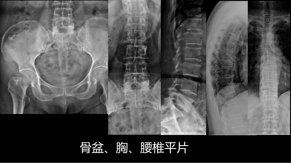 椎体局灶性病变：综合影像学评判_第6页