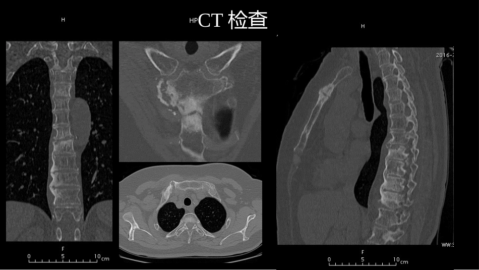 椎体局灶性病变：综合影像学评判_第7页