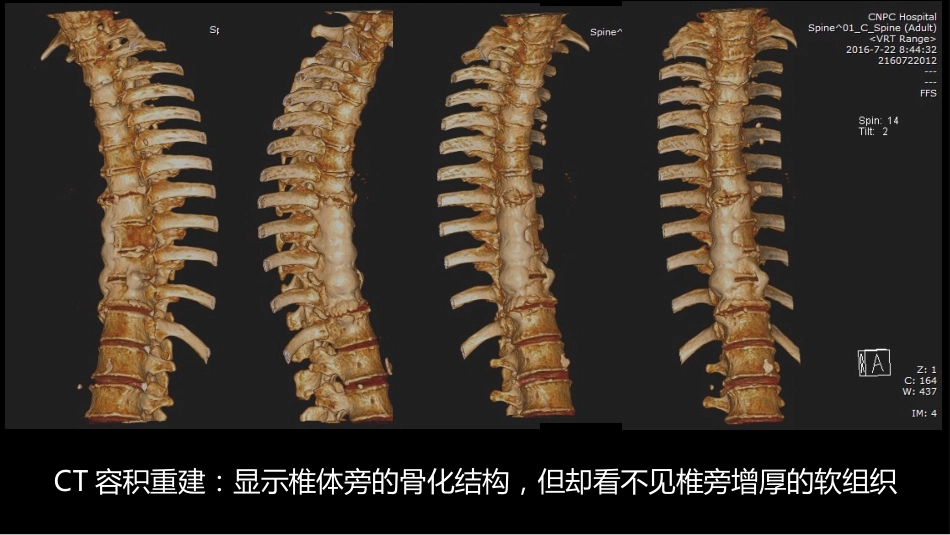 椎体局灶性病变：综合影像学评判_第9页