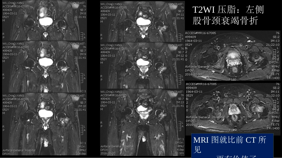 代谢性骨病影像学检查理念暨应用扩展_第13页