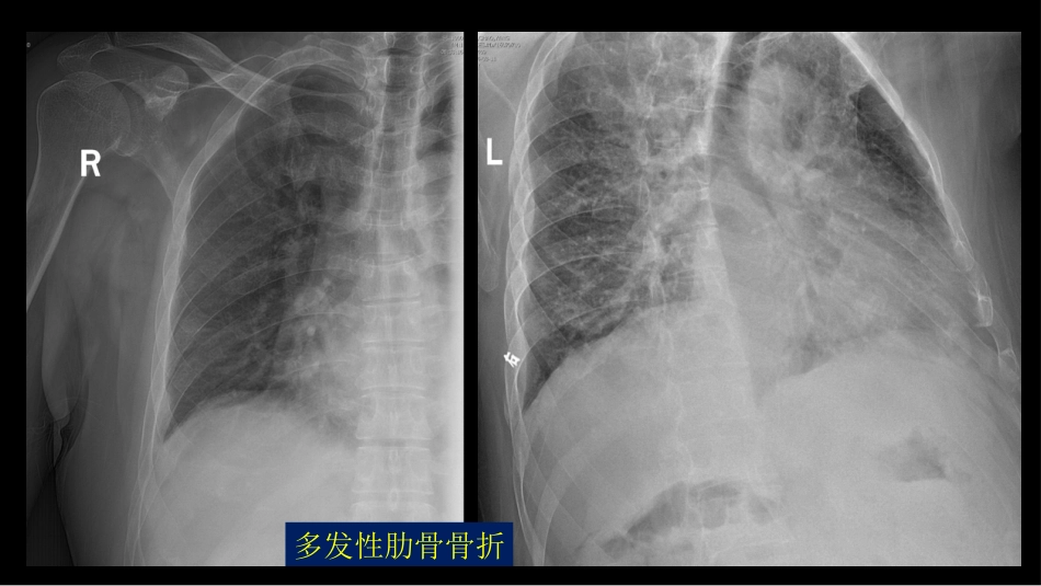 代谢性骨病影像学检查理念暨应用扩展_第6页