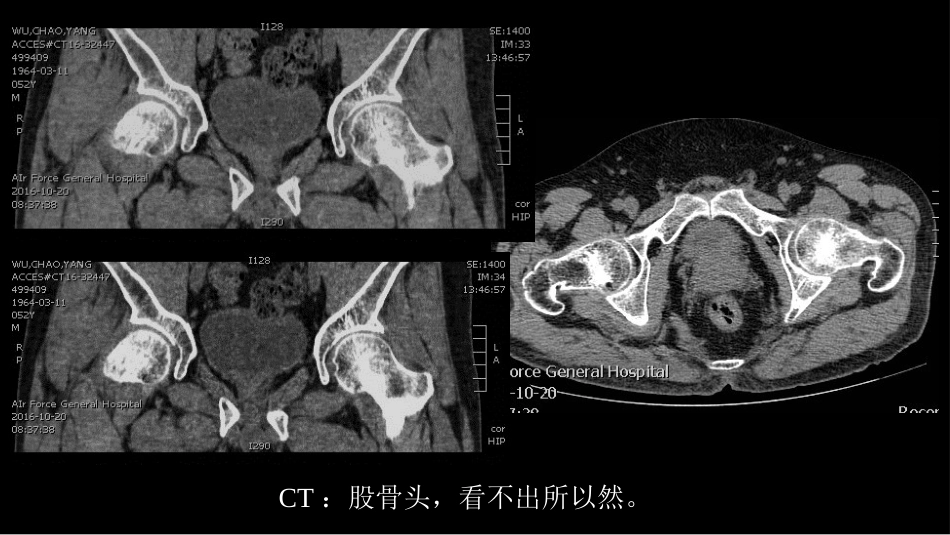 代谢性骨病影像学检查理念暨应用扩展_第7页