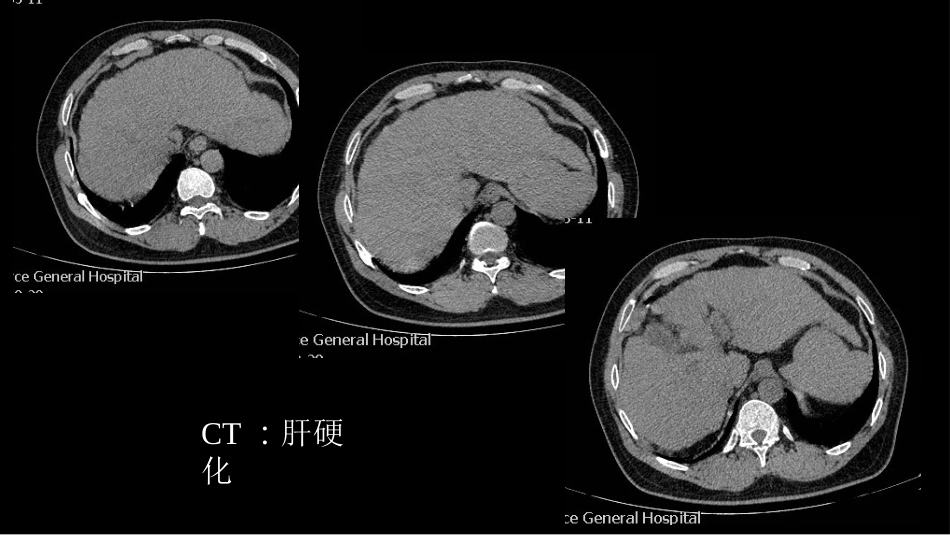 代谢性骨病影像学检查理念暨应用扩展_第9页