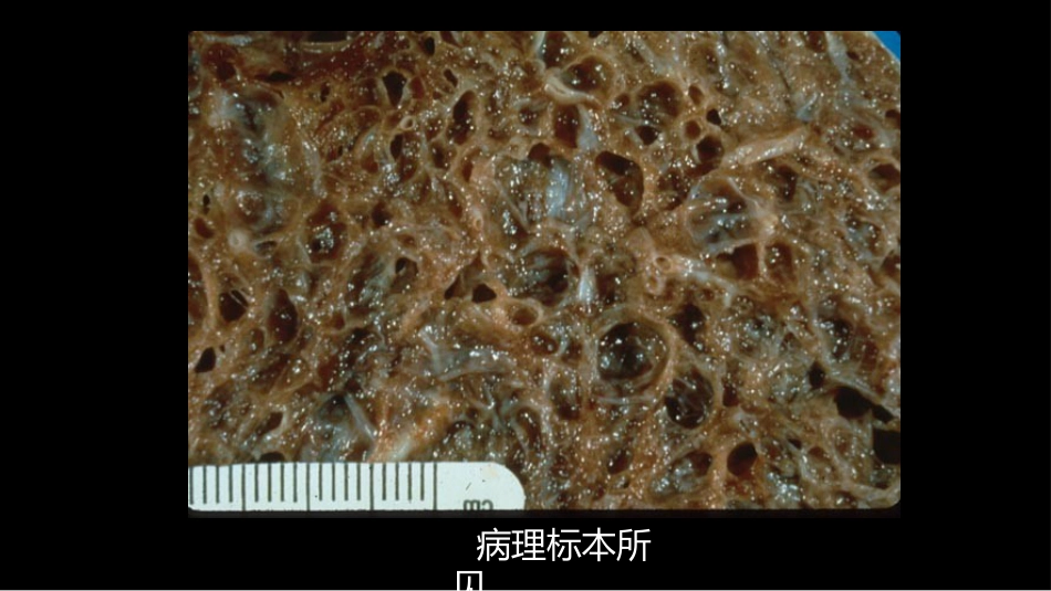 肺淋巴管肌瘤病合并双侧巨大肾血管平滑肌脂肪瘤(X线、CT、MR)_第13页