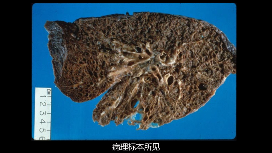 肺淋巴管肌瘤病合并双侧巨大肾血管平滑肌脂肪瘤(X线、CT、MR)_第14页