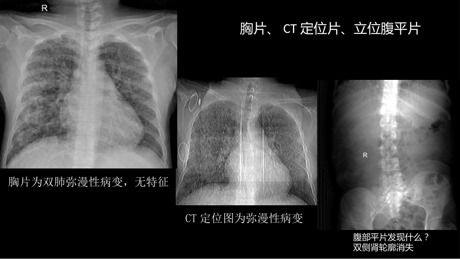 肺淋巴管肌瘤病合并双侧巨大肾血管平滑肌脂肪瘤(X线、CT、MR)_第4页