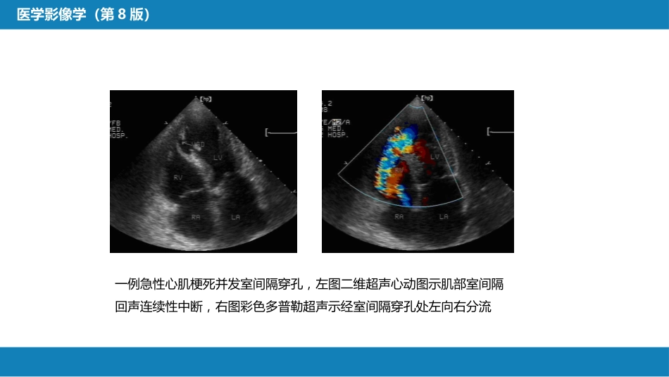 第五章 循环系统 第三节 基本病变表现；第四节 疾病诊断_第11页