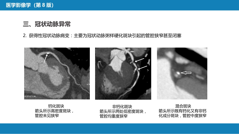 第五章 循环系统 第三节 基本病变表现；第四节 疾病诊断_第13页