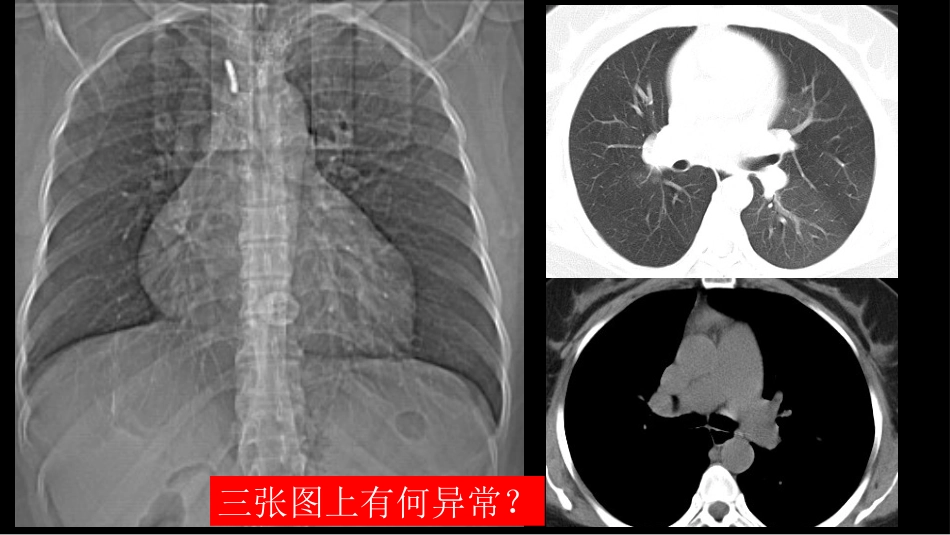 胸部影像解读：心肺一体性疾病_第13页