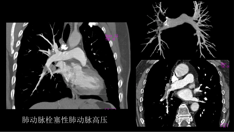 胸部影像解读：心肺一体性疾病_第15页