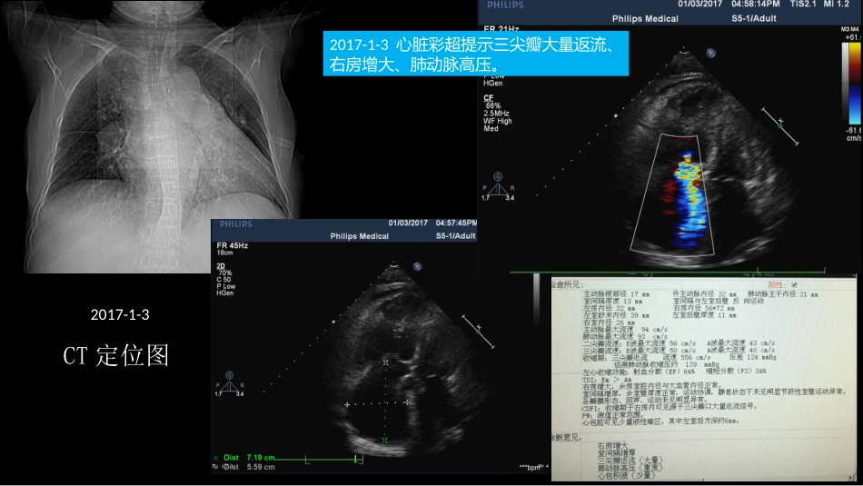 胸部影像解读：心肺一体性疾病_第4页