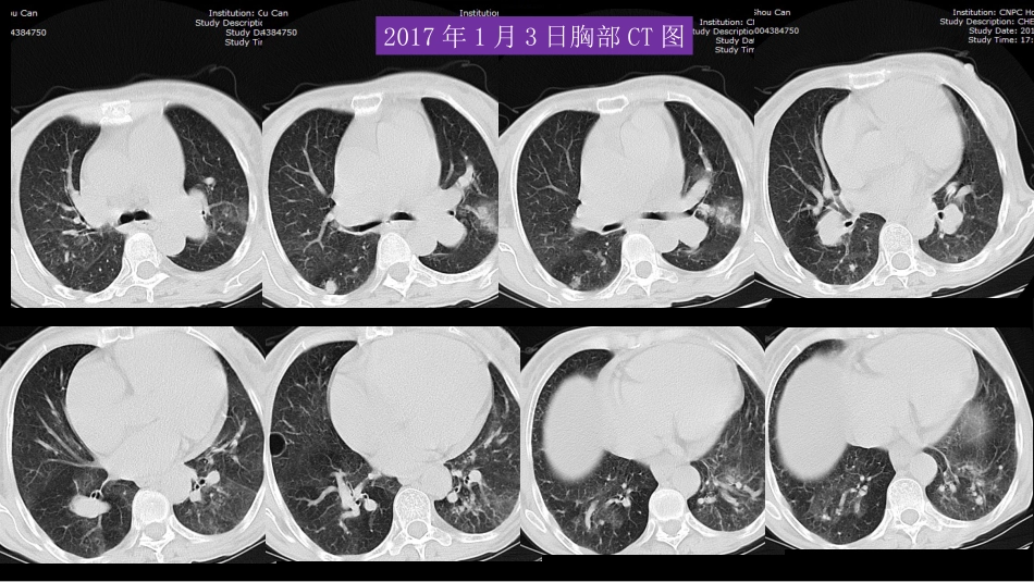 胸部影像解读：心肺一体性疾病_第5页