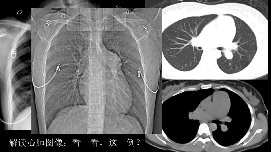 胸部影像解读：心肺一体性疾病_第9页