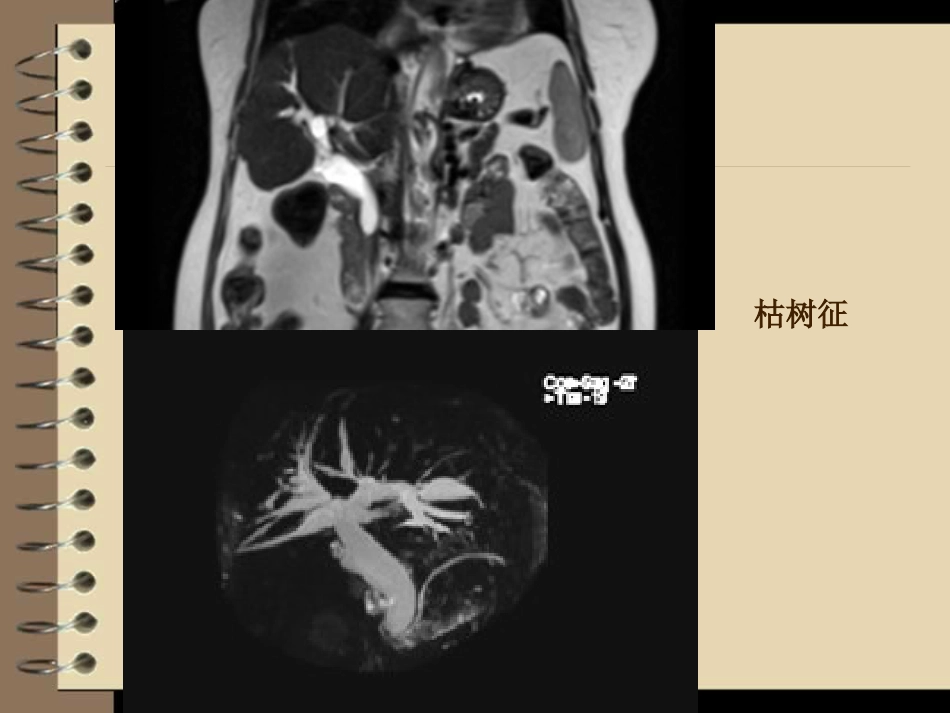 胆道梗阻的影像学诊断_第12页