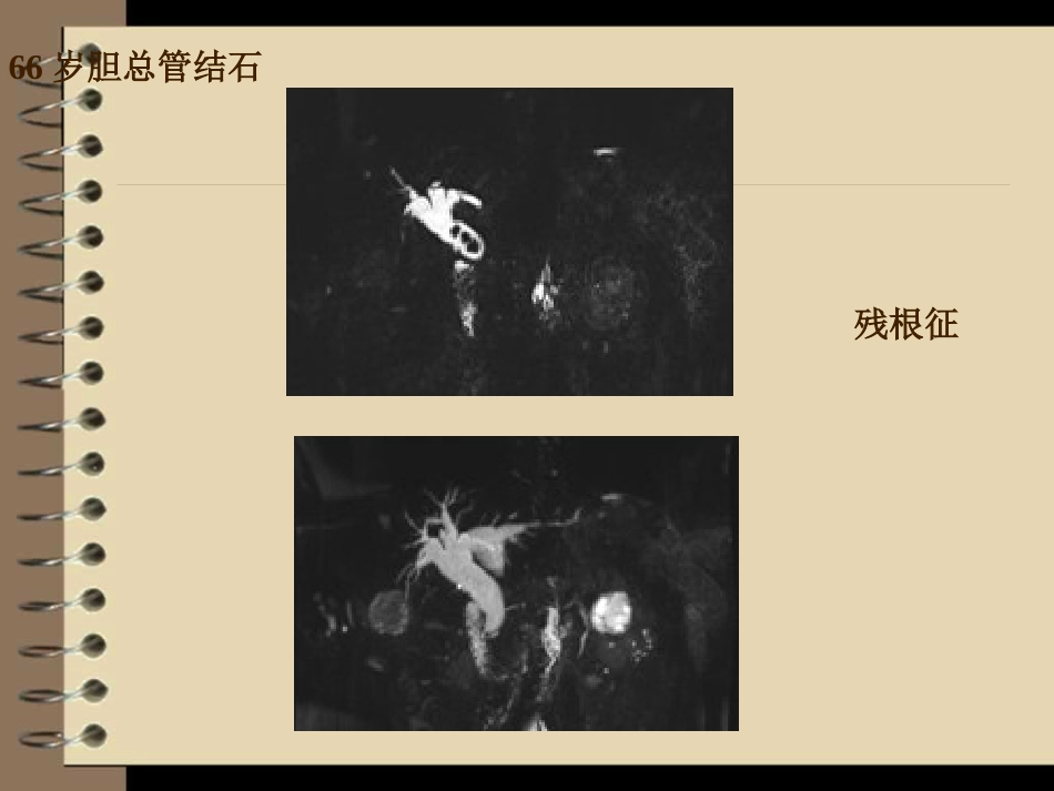 胆道梗阻的影像学诊断_第13页