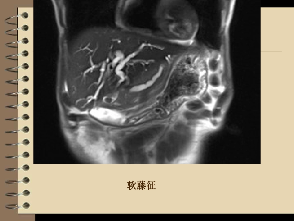 胆道梗阻的影像学诊断_第14页
