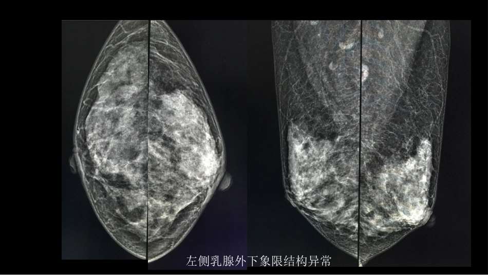 乳腺囊性肿块MRI:鉴别不困难_第4页