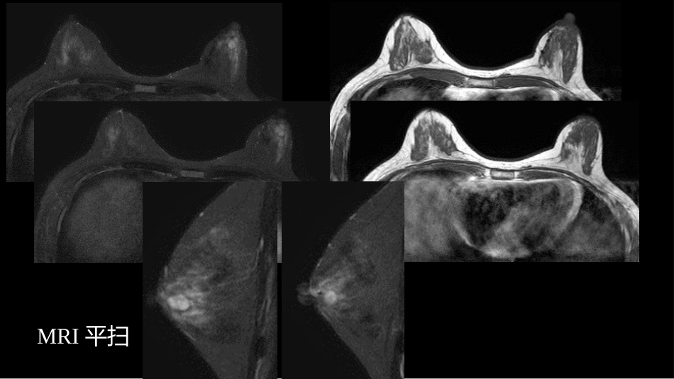 乳腺囊性肿块MRI:鉴别不困难_第5页