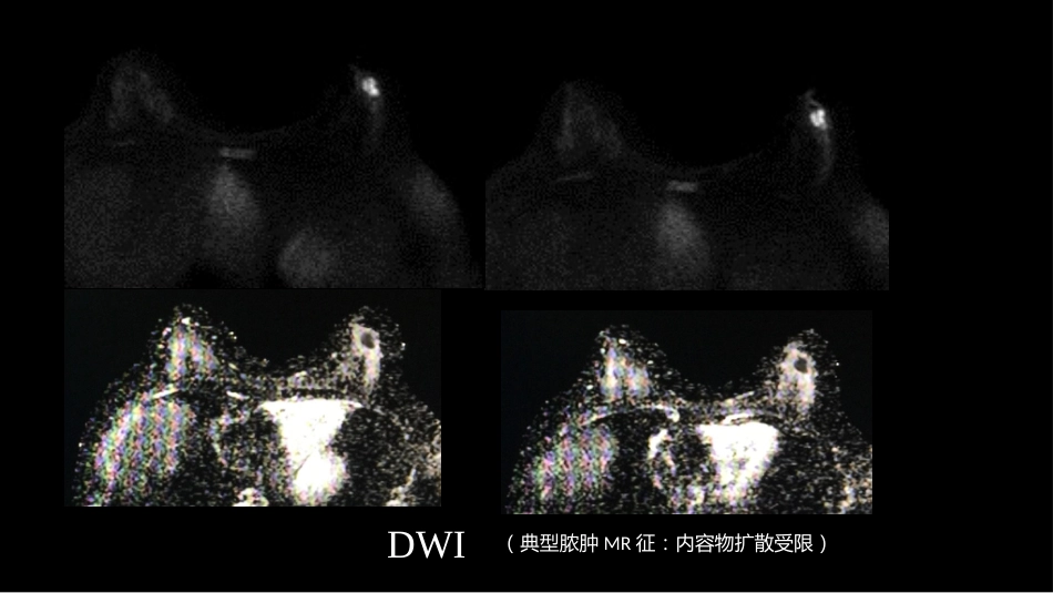 乳腺囊性肿块MRI:鉴别不困难_第6页