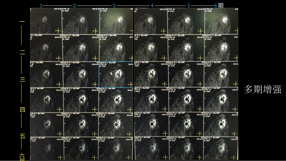 乳腺囊性肿块MRI:鉴别不困难_第7页