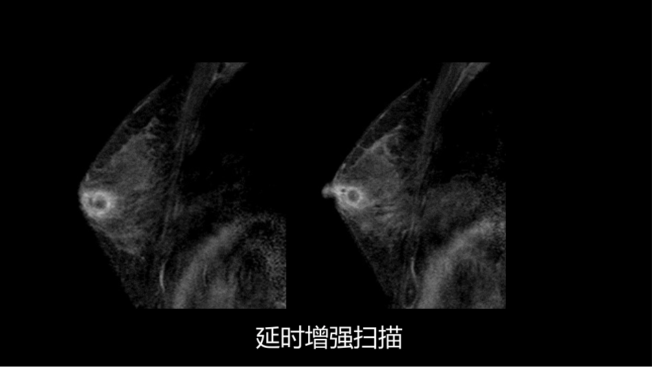 乳腺囊性肿块MRI:鉴别不困难_第8页