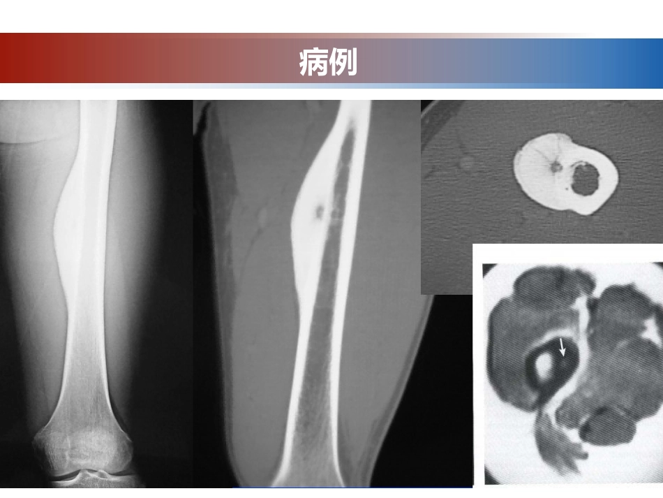 成骨性肿瘤的影像诊断与鉴别诊断_第7页