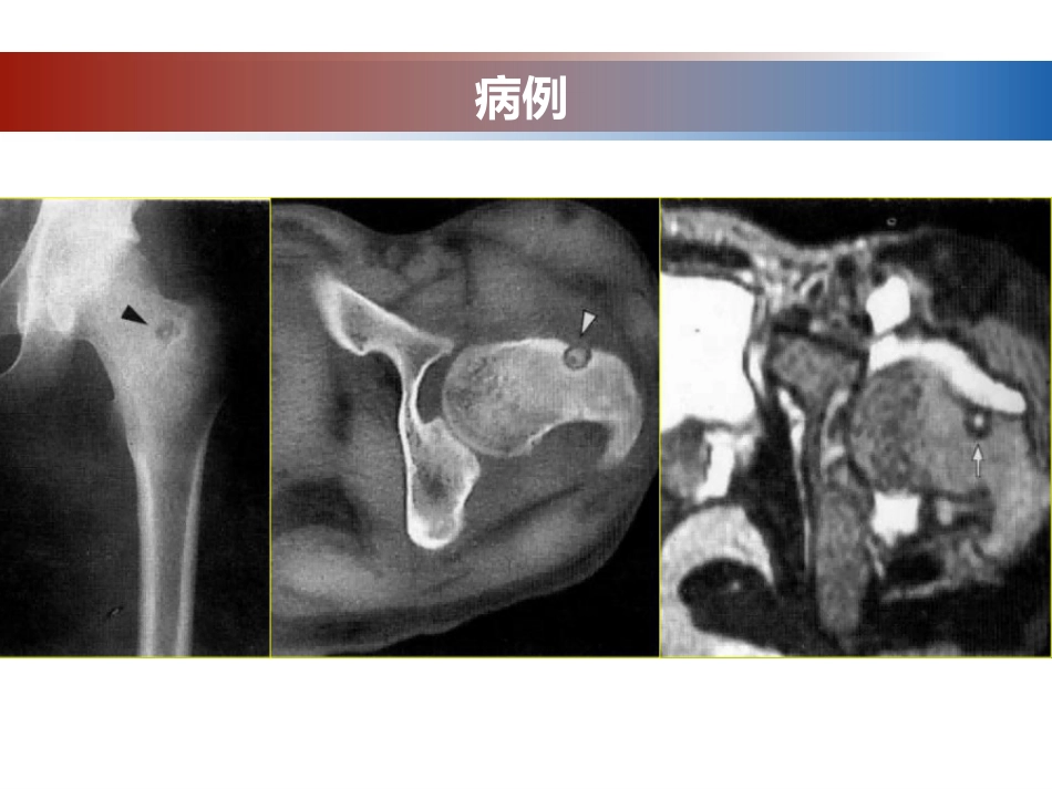 成骨性肿瘤的影像诊断与鉴别诊断_第8页