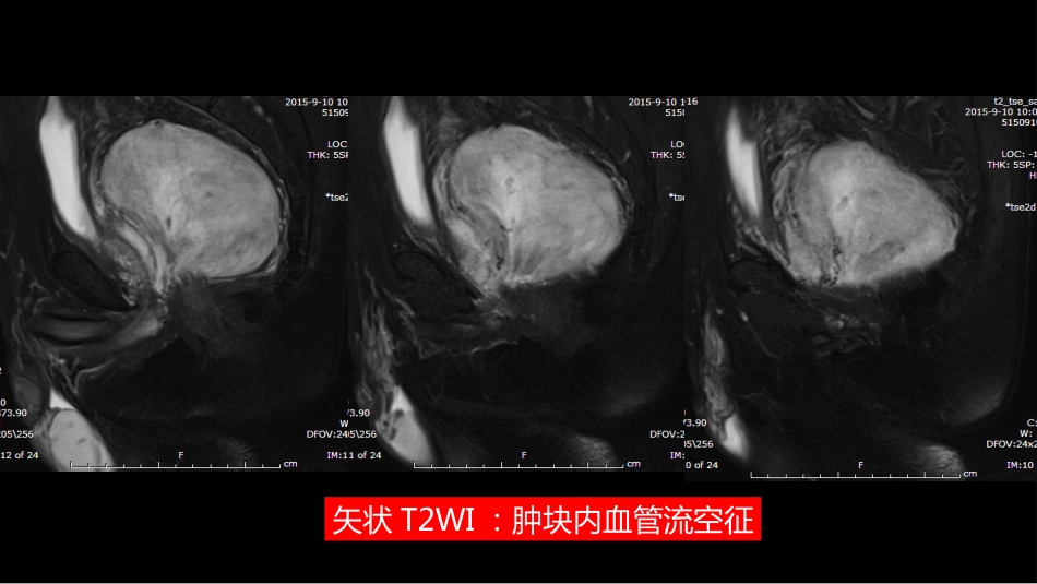 异位前列腺误诊为肿瘤_第12页