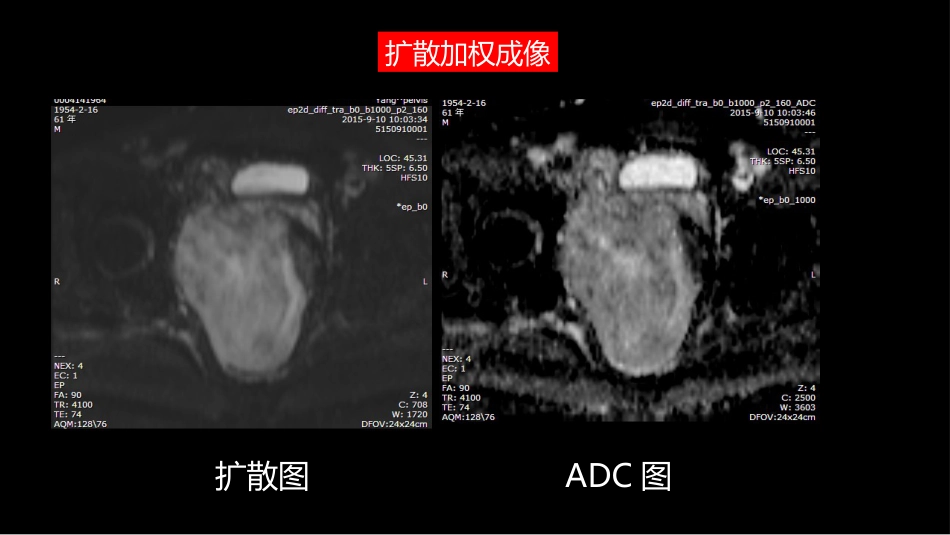 异位前列腺误诊为肿瘤_第13页