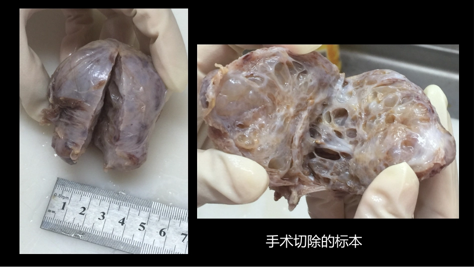 异位前列腺误诊为肿瘤_第8页
