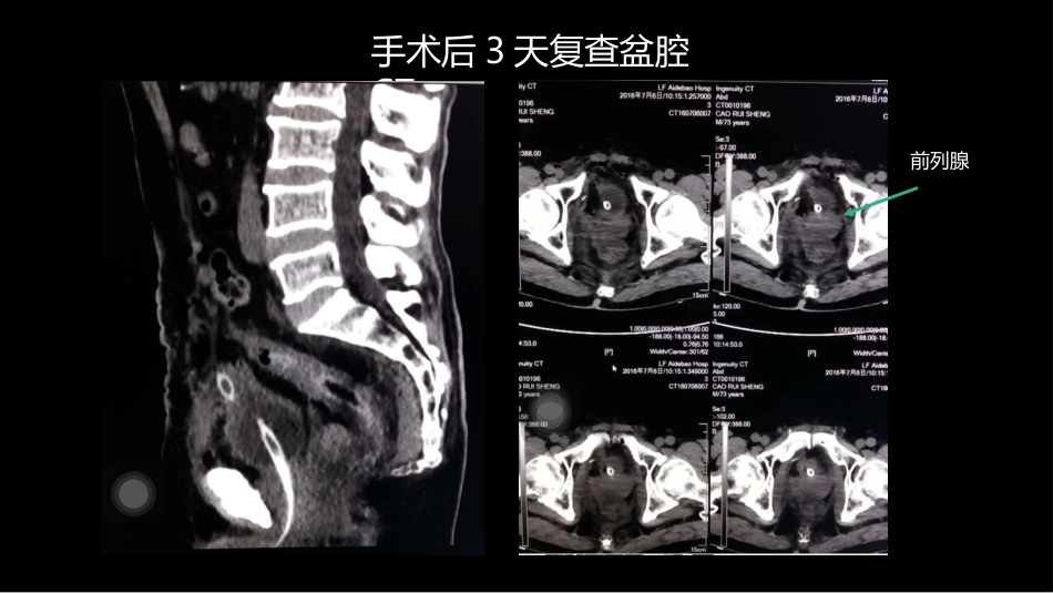 异位前列腺误诊为肿瘤_第9页