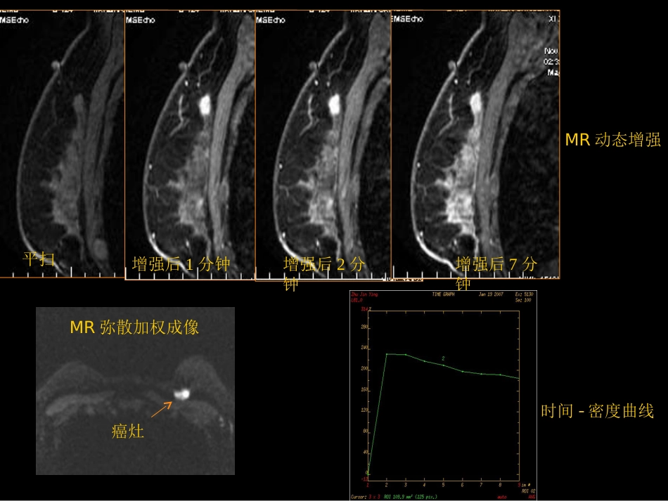 乳腺癌早期影像检查_第13页