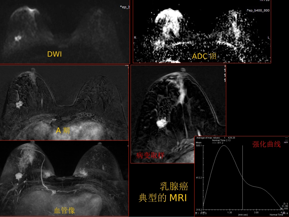 乳腺癌早期影像检查_第14页