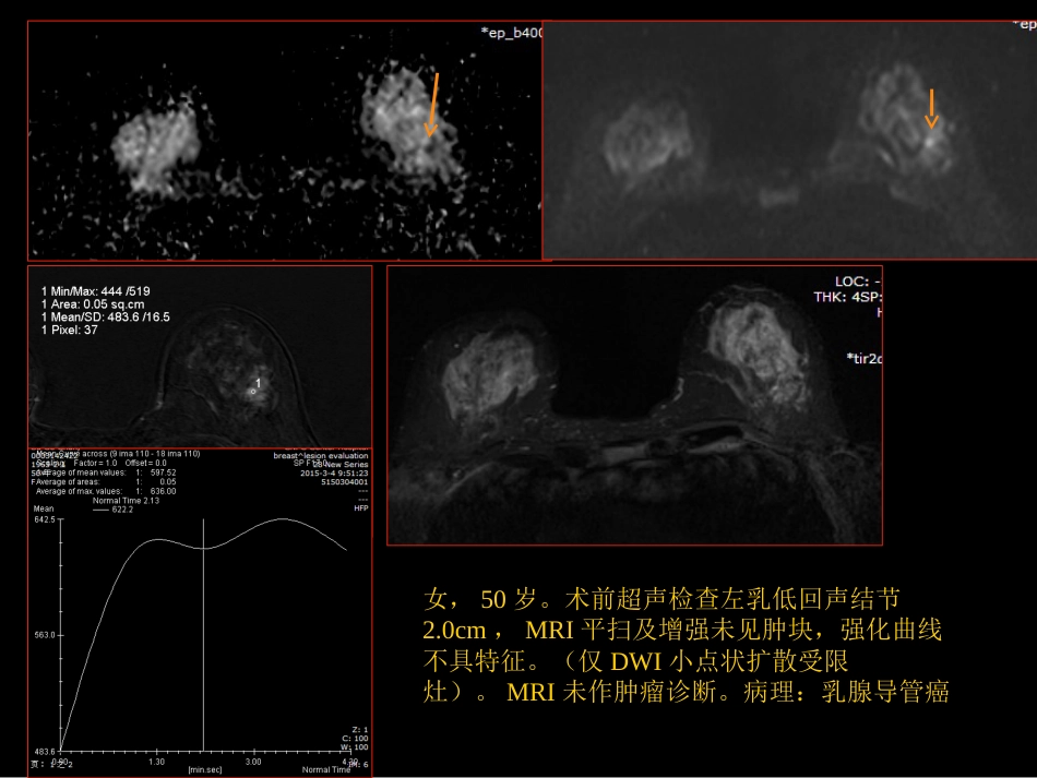 乳腺癌早期影像检查_第15页