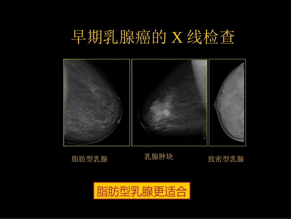 乳腺癌早期影像检查_第5页