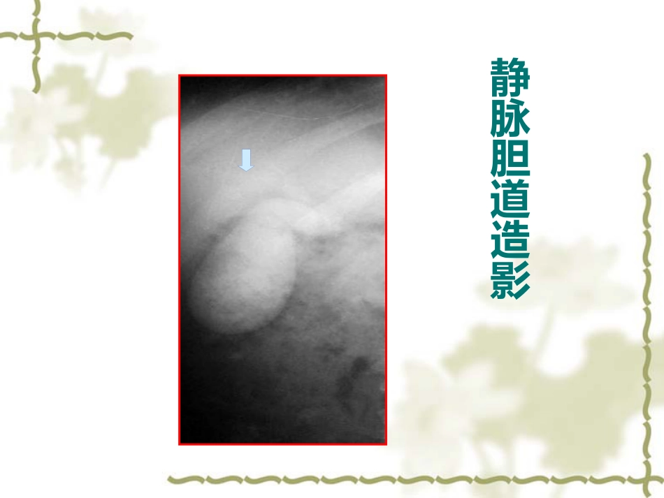 胆道疾病影像学_第10页