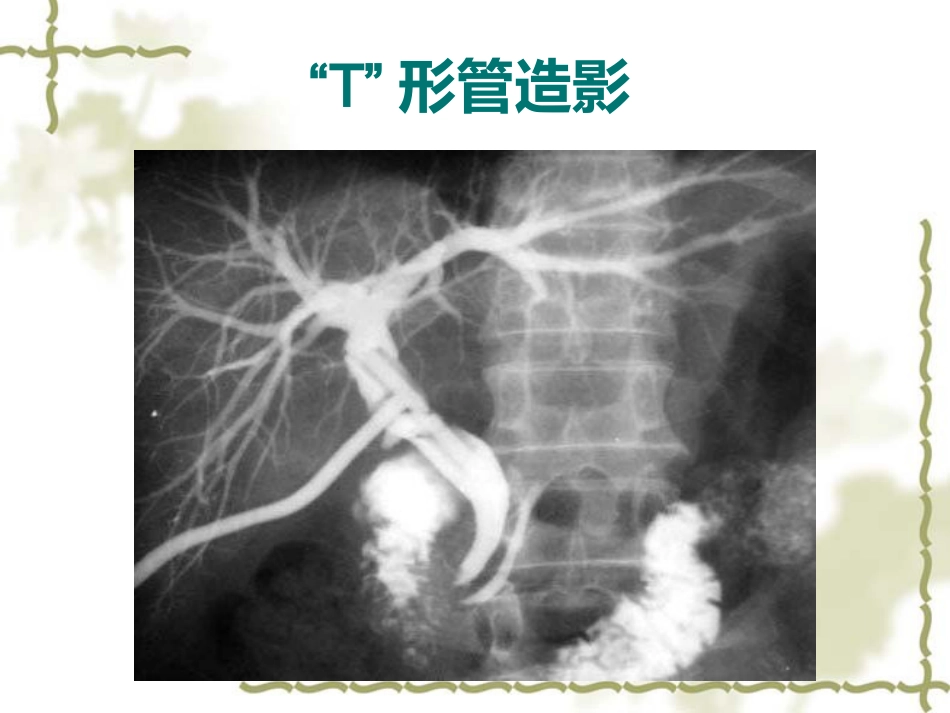胆道疾病影像学_第11页