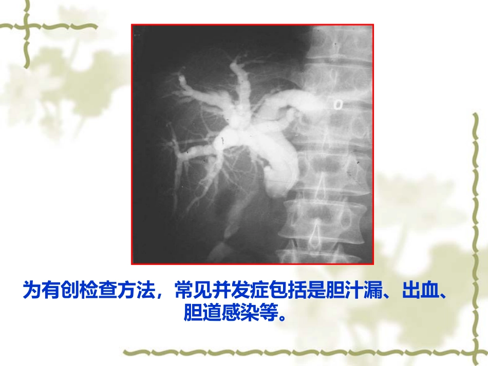 胆道疾病影像学_第14页