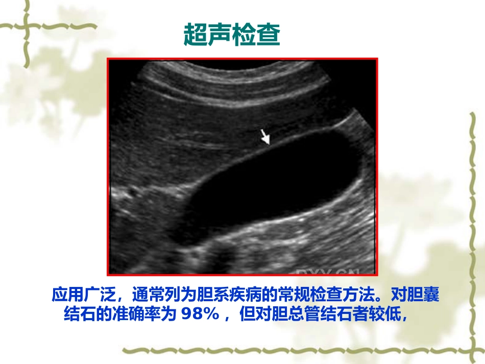 胆道疾病影像学_第5页