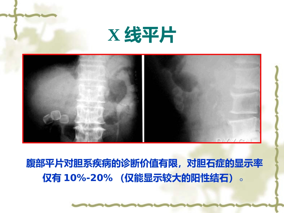 胆道疾病影像学_第6页