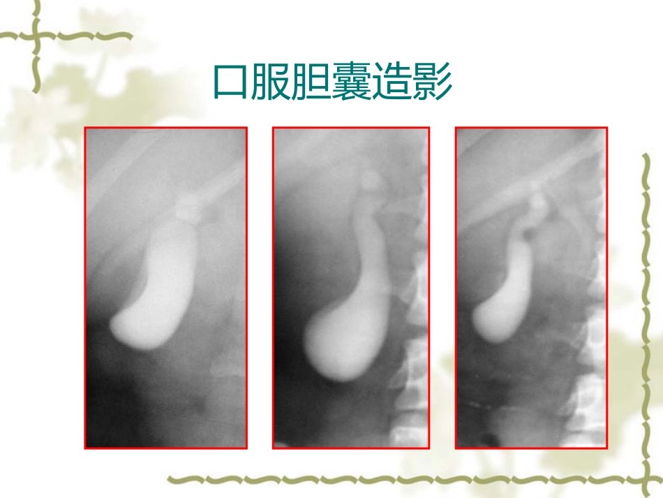 胆道疾病影像学_第9页