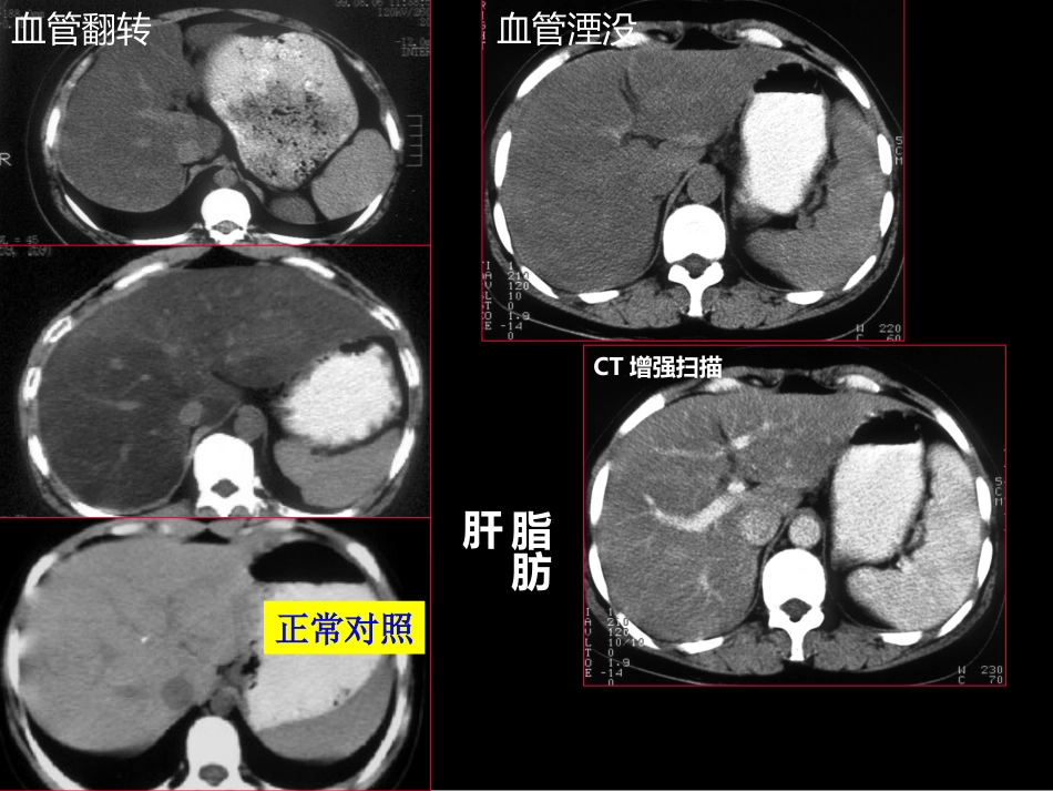 肝胆胰影像学诊断_第15页