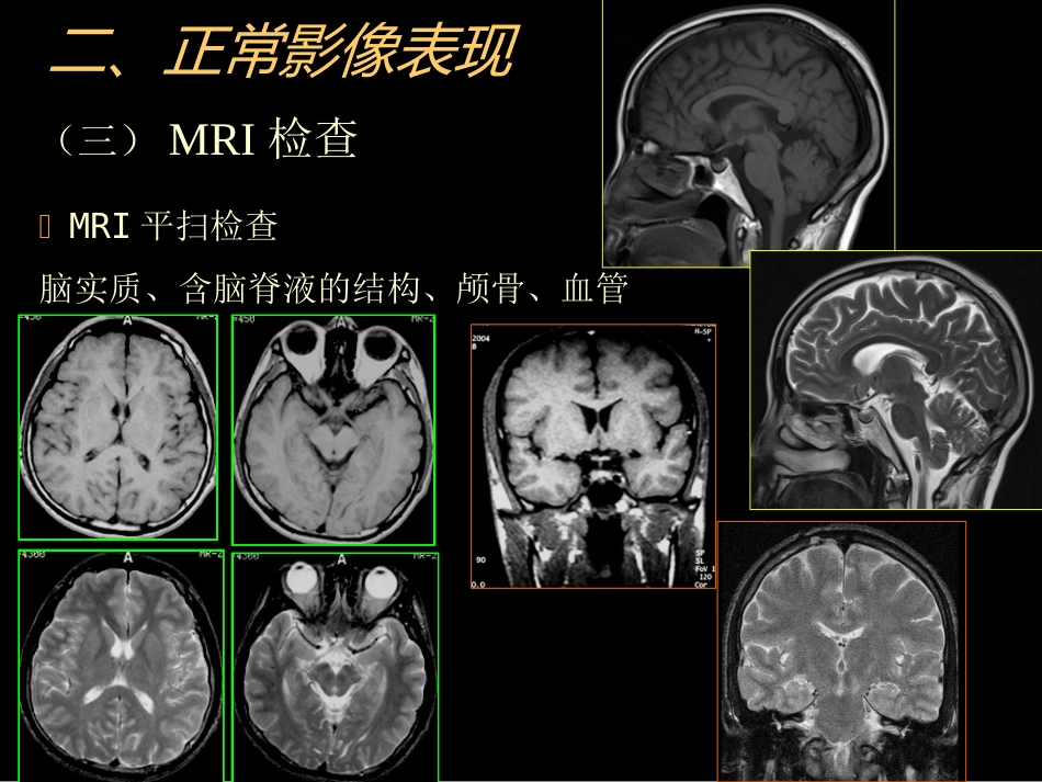 中枢神经(脑、脊髓)影像诊断_第10页