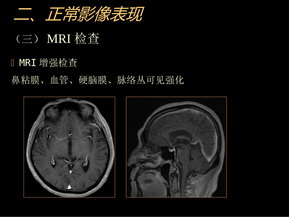 中枢神经(脑、脊髓)影像诊断_第11页