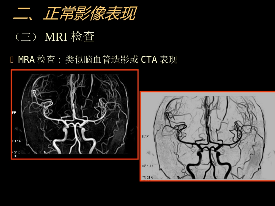 中枢神经(脑、脊髓)影像诊断_第12页