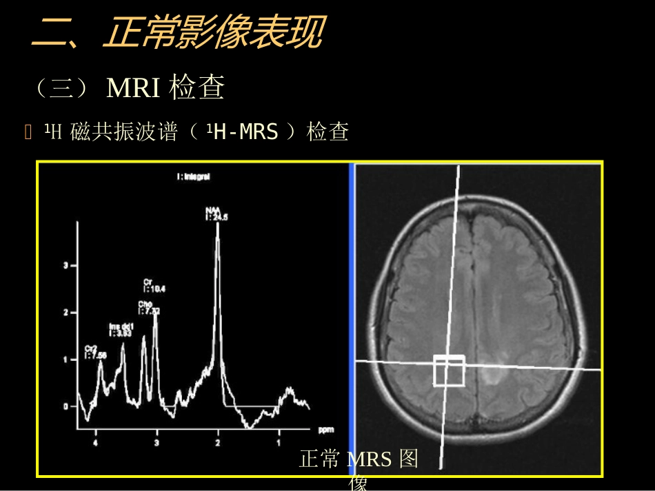 中枢神经(脑、脊髓)影像诊断_第13页