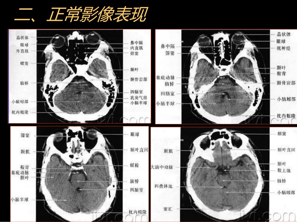 中枢神经(脑、脊髓)影像诊断_第6页