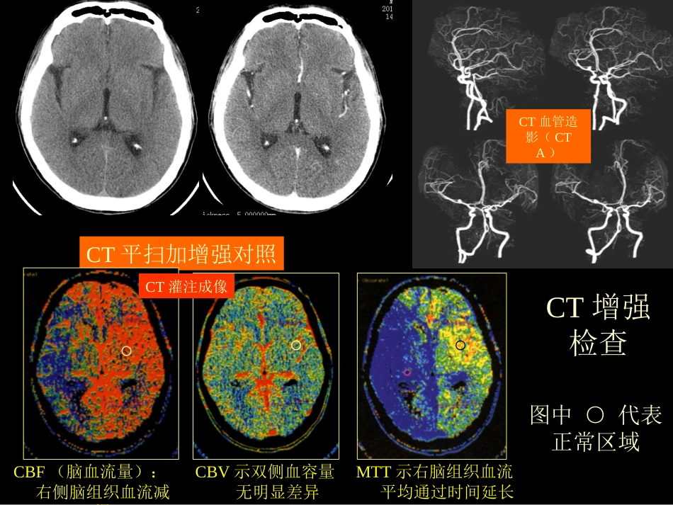 中枢神经(脑、脊髓)影像诊断_第9页