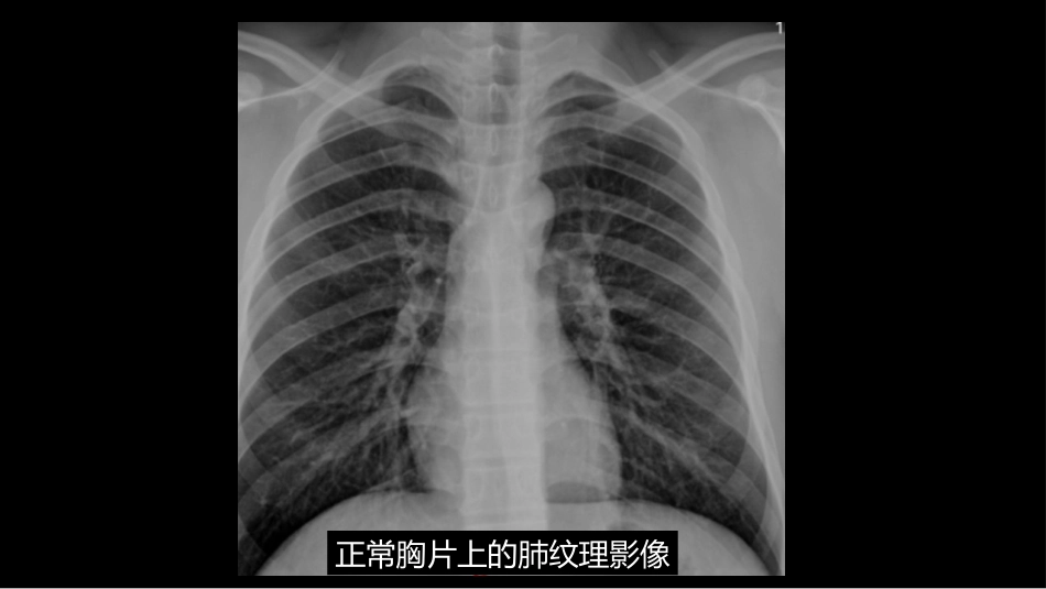 肺血管及肺网状结构影像学与心肺疾病-修改版_第10页